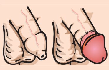 giuseppe-lapera-urologo-andrologo-roma-fimosi-circoncisione