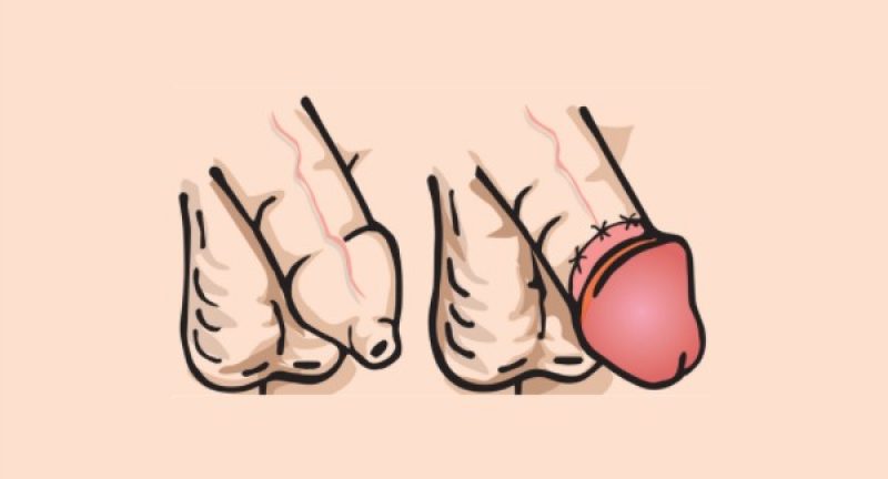 Circoncisione: quanto sai della fimosi e della circoncisione?