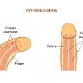 Malattia di Peyronie: sintomi e trattamenti