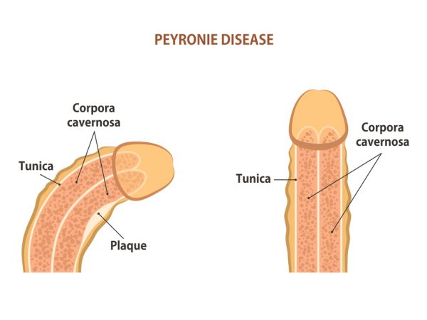 Malattia di Peyronie: sintomi e trattamenti