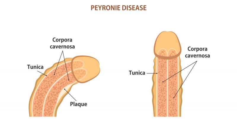 Malattia di Peyronie: sintomi e trattamenti