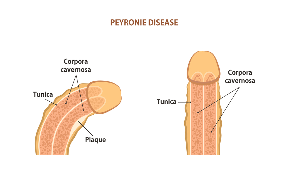 Malattia di Peyronie