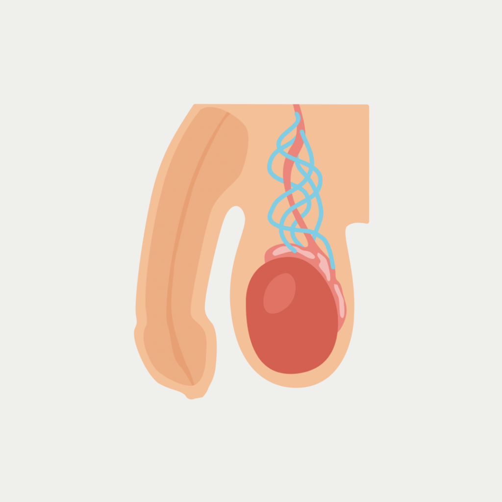 Varicocele
