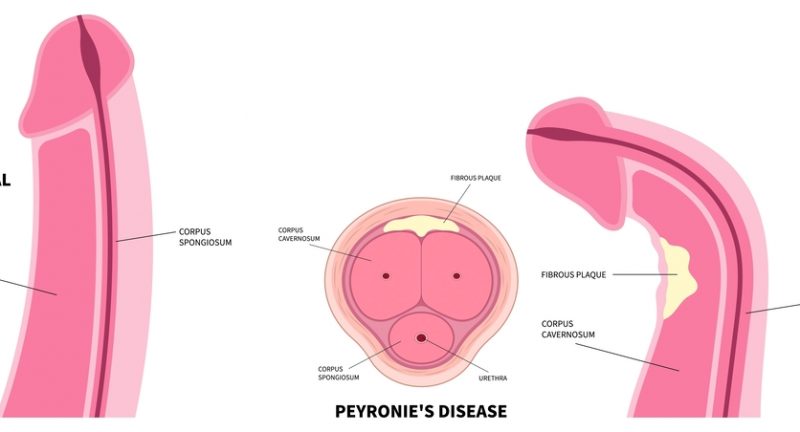 Come capire se si ha la malattia di Peyronie? Guida ai sintomi