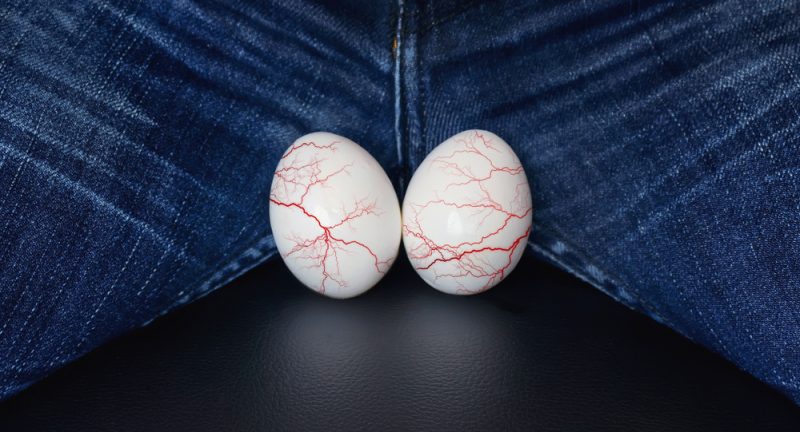 Che succede se non si cura il varicocele? I rischi per la fertilità
