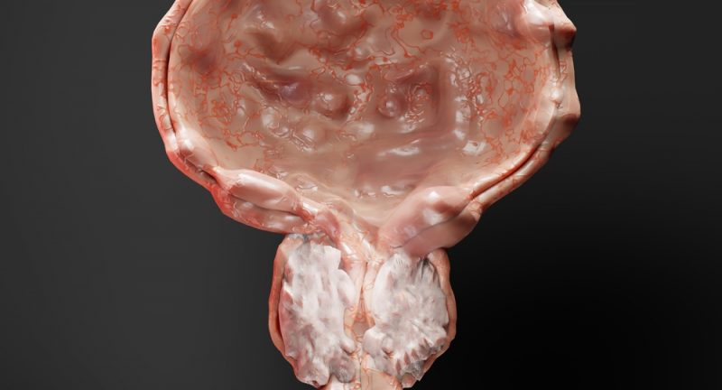 Quali sono i sintomi di una ipertrofia prostatica benigna? Diagnosi e trattamento